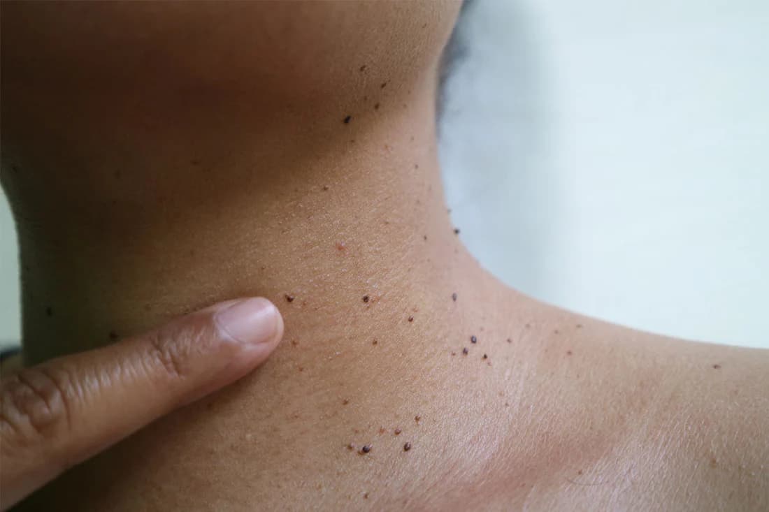 Mole, wart and skin tag removal at Calyx Skin Lab