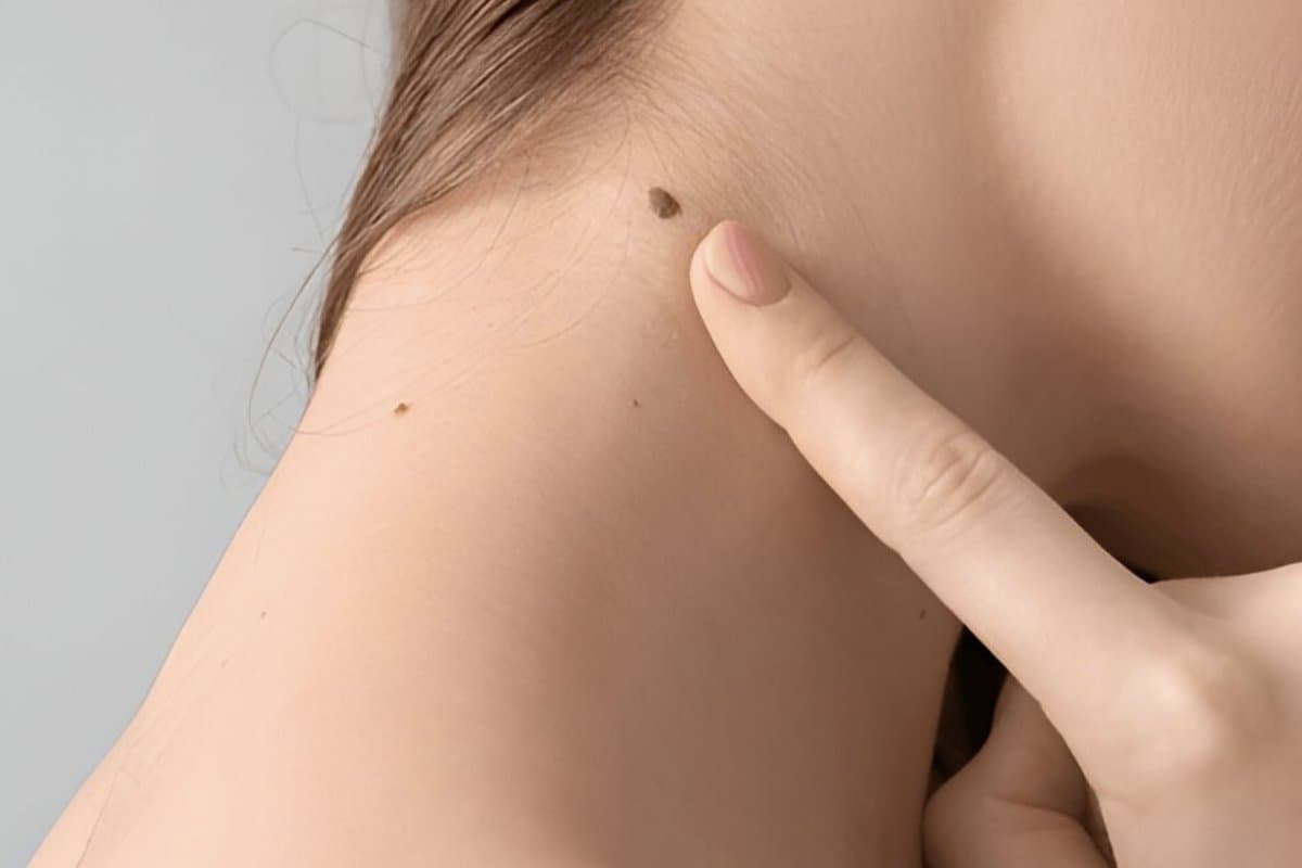 Dermatologist examining a mole on a patient's neck